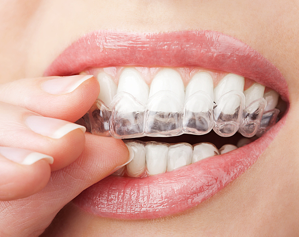 Invisalign Treatment